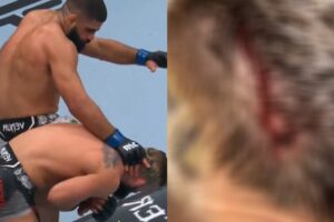 Blessure horrible d'un combattant lors d'un accident UFC